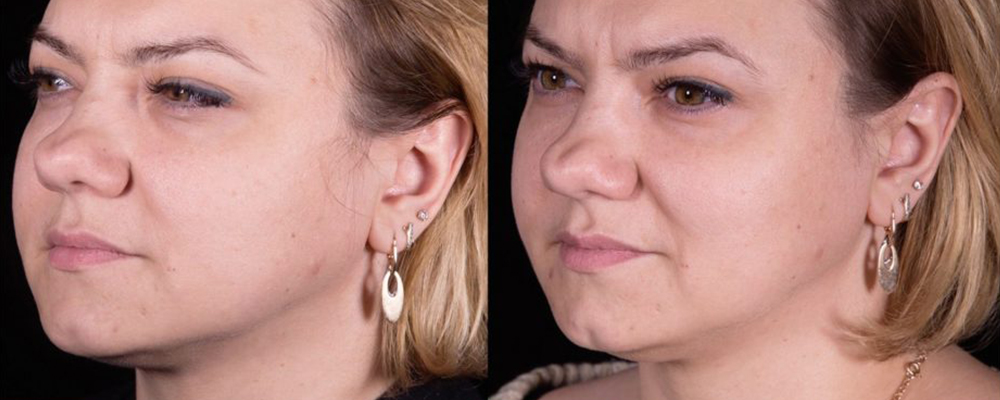 مزوژل پروسترولین اینر بی