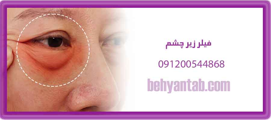 عوارض فیلر زیر چشم